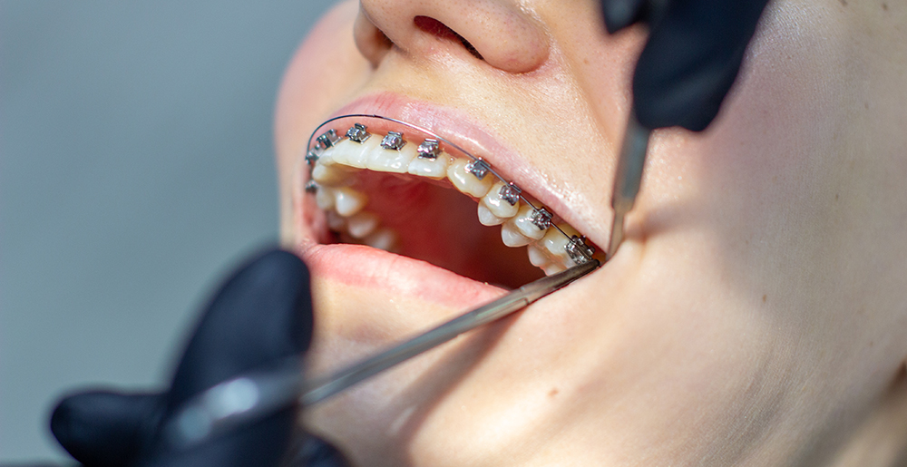 Best Braces Treatments in Gujranwala | Medicoma Complex